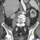 Spondylodiscitis, abscess of psoas muscle, drainage of abscess: CT - Computed tomography